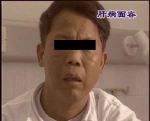 什么是肝病面容呢?